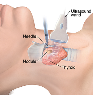 Side view of neck showing thyroid with nodule. Ultrasound probe is on skin above thyroid. Needle is being inserted through skin into nodule.