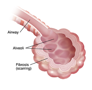 Closeup of airway and alveoli with fibrosis.