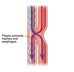 Side view of trachea and esophagus showing tracheoesphageal fistula.