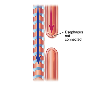 Side view of trachea and esophagus showing esophageal artresia.