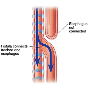 Side view of trachea and esophagus showing combination of fistula and artresia.