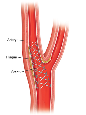 Cross section of carotid artery with stent holding artery open.