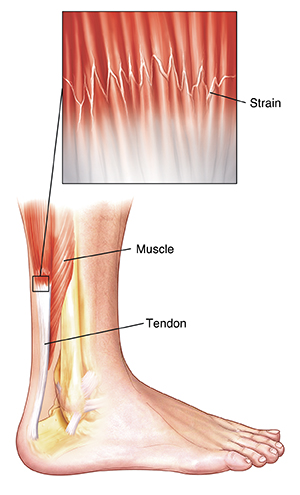 Side view of lower leg showing leg and heel bones, muscle, and tendon. Closeup shows strain in muscle near tendon.