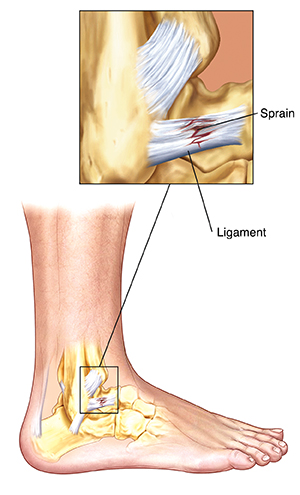 Side view of lower leg showing leg and heel bones and ligaments. Closeup shows sprain in ligament.