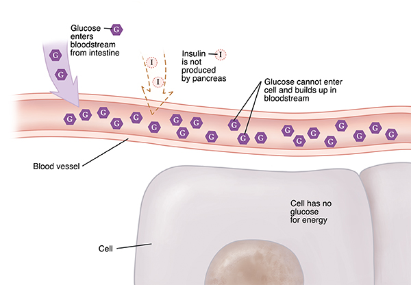 Closeup cross section of blood vessel near cells showing Type 1 diabetes. Insulin not produced. Glucose can't enter cells and builds up in bloodstream. Cell has no glucose for energy.