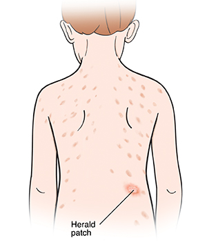 Outline of child from back showing rash on back. One large spot of rash is herald patch.