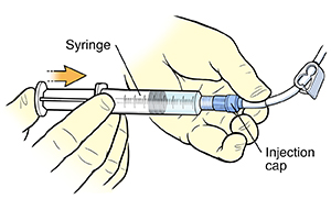 Closeup of gloved hands using needleless syringe to inject solution into catheter injection cap.