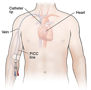 Outline of human figure with catheter inserted into right arm at elbow. Two ports are at end of catheter. Catheter can be seen going up arm vein into heart.
