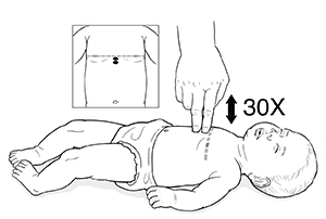Infant lying flat on back. Adult hand performing CPR by pressing down on chest with two fingers. Inset of infant torso with dotted line and two dots showing placement of fingers in center of chest and directly below nipple line.