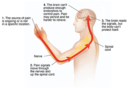 Outline of person with arm raised showing pain cycle. The source of pain is ongoing or is not in a specific location. Pain signals move through the nerves and up the spinal cord. The brain reads the signals, but the body can't protect itself. The brain can't produce enough endorphins to control pain. Pain may persist and be harder to relieve.