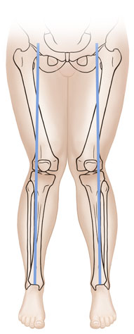 Front view of knock knees showing the bones. 