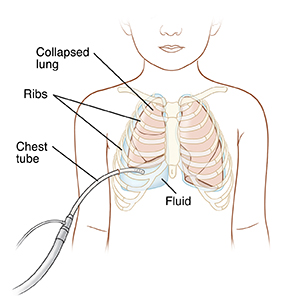 Outline of child showing lungs and chest tube draining fluid.