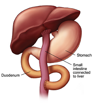 Front view of liver, and stomach showing small intestine connected to liver after Kasai Procedure.