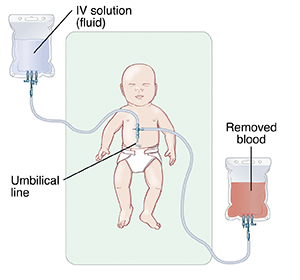 Baby with IV inserted in belly button. IV is connected to bag with IV solution (fluid). Another part of IV is connected to bag with removed blood.