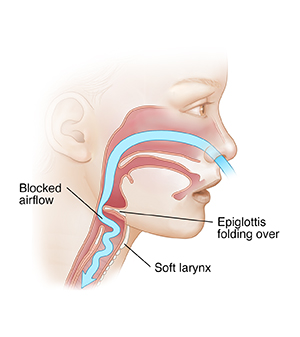 Side view of child's face showing blocked air flow caused by laryngomalacia.