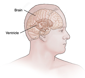 Front view of man’s head and chest showing brain and ventricles.