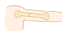 Upper arm bone showing nondisplaced fracture.
