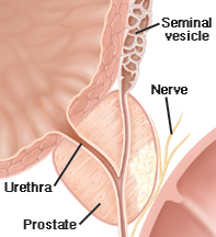 Cross section of prostate showing urethra, seminal vesicles, and nerve.