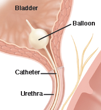 Cross section of bladder showing balloon catheter.