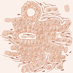Illustration showing abnormal cells tMicroscopic view of Grade 3 prostate cancer cells.hat vary in size and shape with fewer rings in grade 3 of prostate cancer