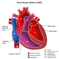 Anatomy of a heart with an atrial septal defect