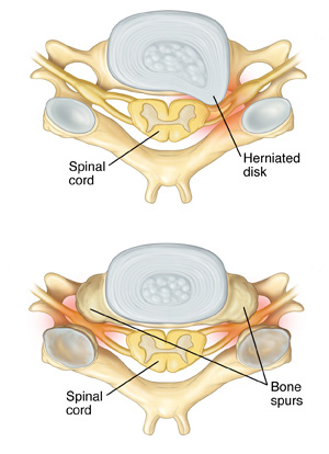 Top view of cervical vertebra showing herniated disk. Top view of cervical vertebra showing bone spurs.