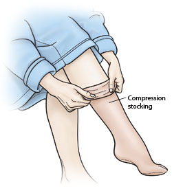 Person pulling a compression stocking onto leg.