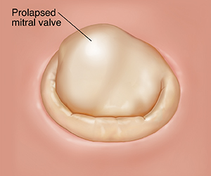 Top view of closed mitral valve with prolapse.