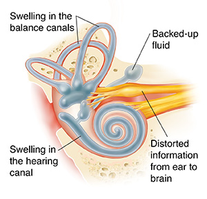Cross section of ear showing cochlea with Meniere's disease.