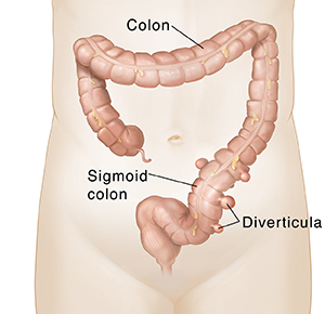 Front view of colon with diverticula pouches in lower part.