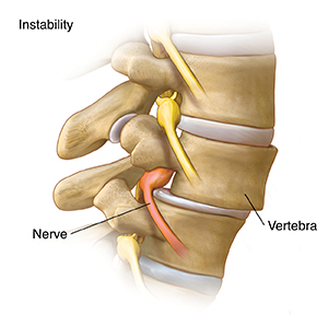 Common Spine and Disk Problems