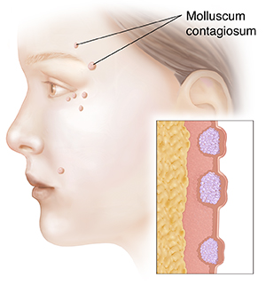 Side view of woman's face showing molluscum contagiosum. Inset shows cross section of molluscum contagiosum.