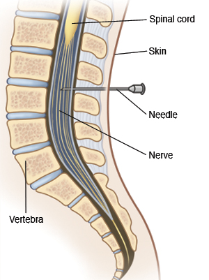 Side view cross section of lower spine showing needle inserted for lumbar puncture.