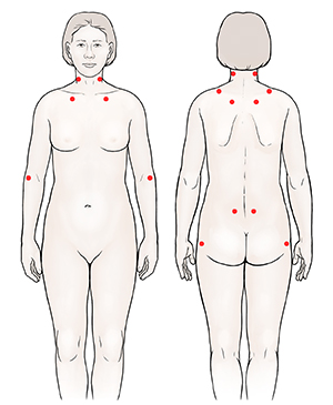 Front and back views of woman showing common fibromyalgia tender points.