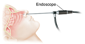 Side view of head showing sinuses and scope inserted into nose. Person is looking in other end of scope.