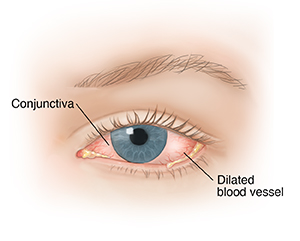 Front view of eye showing conjunctivitis.