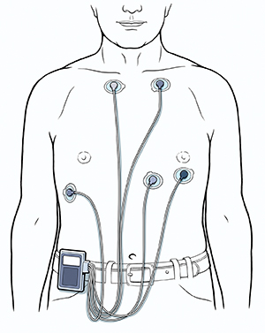 Man's torso showing five ECG leads attached to chest, connected to Holter monitor clipped to belt.