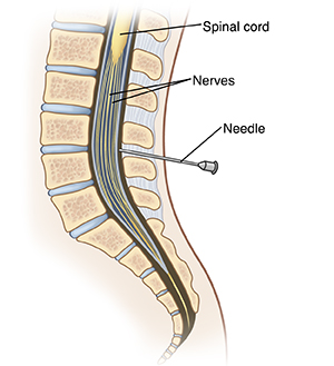 Cross section of lumbar spine showing needle inserted into epidural space.