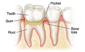Teeth in gums showing periodontitis.