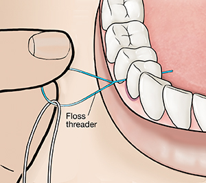 Closeup of fingers inserting floss between teeth with floss threader.