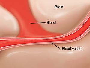 Cross section of artery in brain showing leaking blood causing vasospasm.