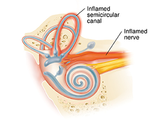 Inner ear with inflammation of semicircular canal and nerve.