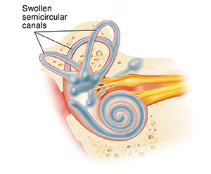 Inner ear showing increased fluid and swelling.