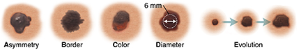 Mole with asymmetrical shape. Mole with uneven, blurry borders. Mole with dark and light spots. Mole with 6 mm measurement across diameter. Three moles showing changes in mole over time.