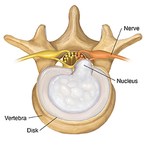 Top view of lumbar vertebra with extruded herniated disk.