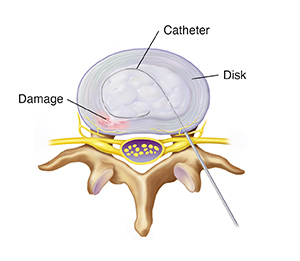 Top view of lumbar vertebra and disk showing needle inserting cathether into disk.