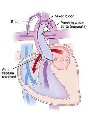 Front view cross section of heart showing Norwood procedure. Patch widens aorta (neoaorta), atrial septum is removed, and shunt goes from artery branching from aorta to pulmonary artery. Arrows show blood flowing from left atrium to right ventricle and mixed blood going from right ventricle to aorta. Some blood from aorta goes through shunt to pulmonary artery.
