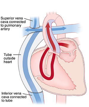 Front view cross section of heart showing Fontan procedure for hypoplastic left ventricle. Superior vena cava is connected to pulmonary artery. Tube outside heart is connected to inferior vena cava at bottom and superior vena cava at top. Arrows show blood flowing from left atrium to right ventricle, then being pumped out aorta.