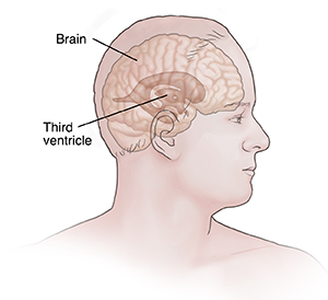 Side view of man's head showing third ventricle in brain.