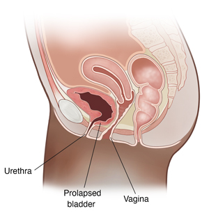 Side view cross section of female pelvic area showing prolapsed bladder (cystocele).